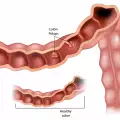 Как да се предпазим от полипи на дебелото черво?