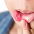 Лечение на афти в устата