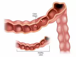 Как да се предпазим от полипи на дебелото черво?