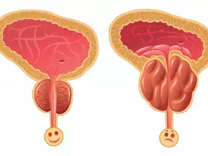 Аденом на простатата