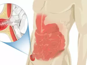 Как да разпознаем хернията