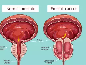 9 съвета за профилактика срещу рак на простатата