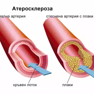Работният стрес, малкото сън и високото кръвно налягане – смъртоносна комбинация