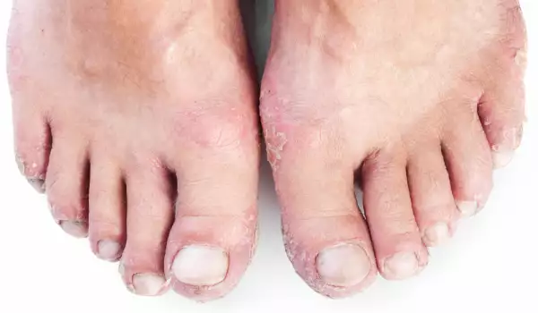 10 болести, които краката ви издават