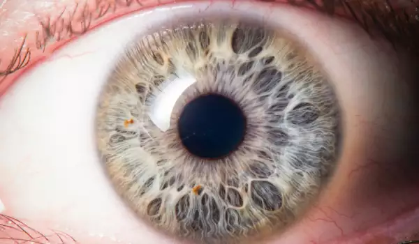 Какво показват за здравето ви луничките на очите