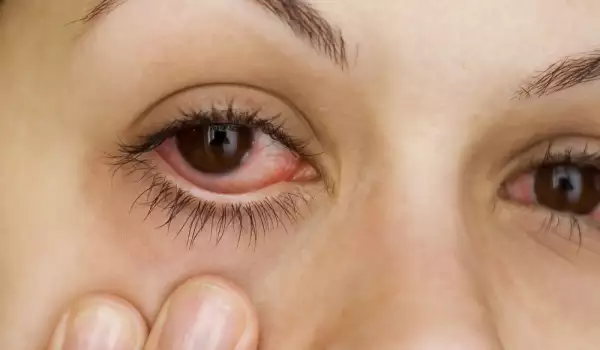Кръвоизлив в окото - причини и лечение