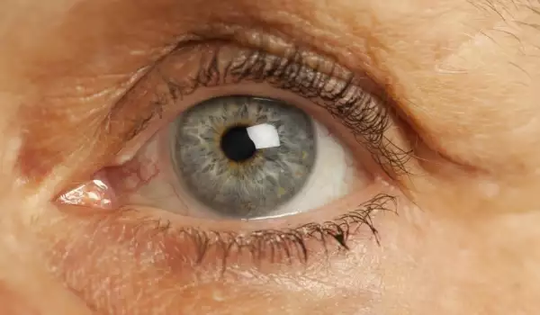 Какво представлява глаукомата и как да се предпазим от нея