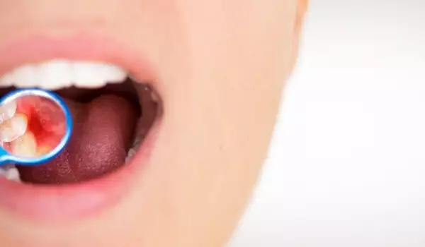 Какви бактерии могат да причинят проблеми в устата ви?
