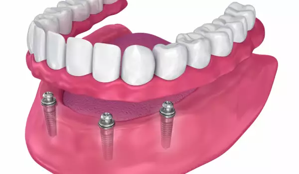 Поставяне на зъбни импланти