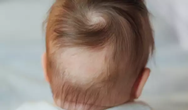 загуба на коса при дете