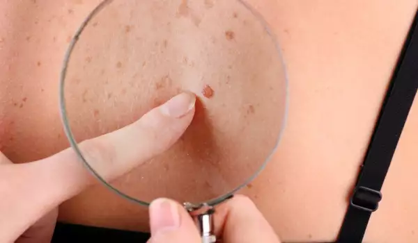 Как да си направим сами преглед за рак на кожата