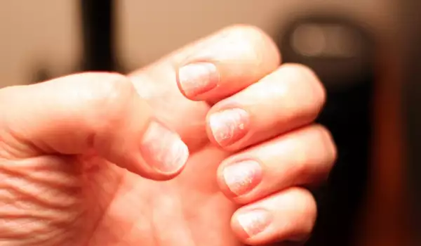 Това са причините за чупливи нокти