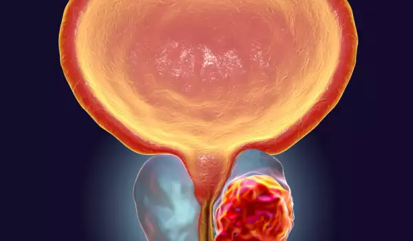 Всичко, което трябва да знаете за рака на простатата