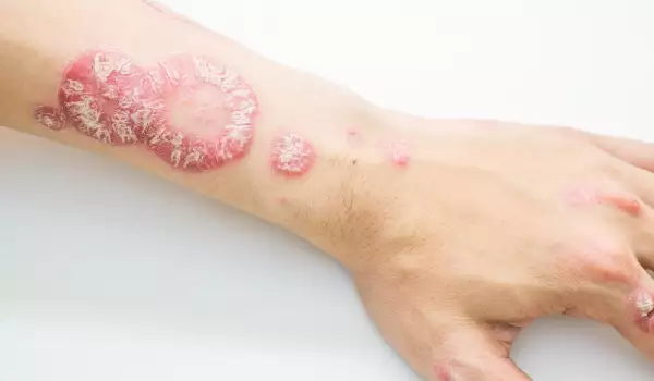 Опасният сърбеж по кожата ви може да е псориазис