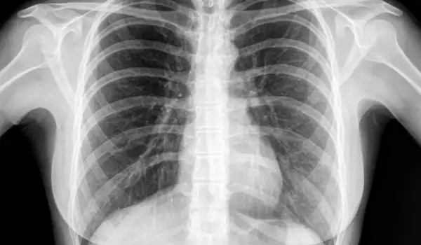 Колко опасни са рентгеновите снимки?