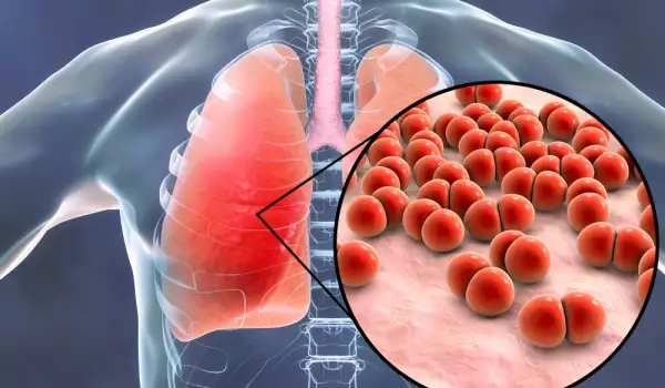 Симптоми за пневмония и как да се излекуваме