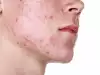 Акне