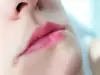 Импетиго