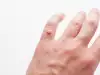 Лечение на кондиломи с народна медицина